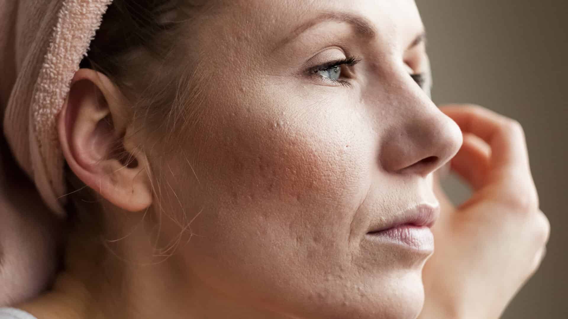 Pimple In Adults